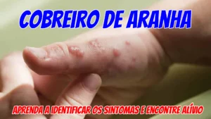Cobreiro de aranha - Aprenda a identificar os sintomas e encontre alívio