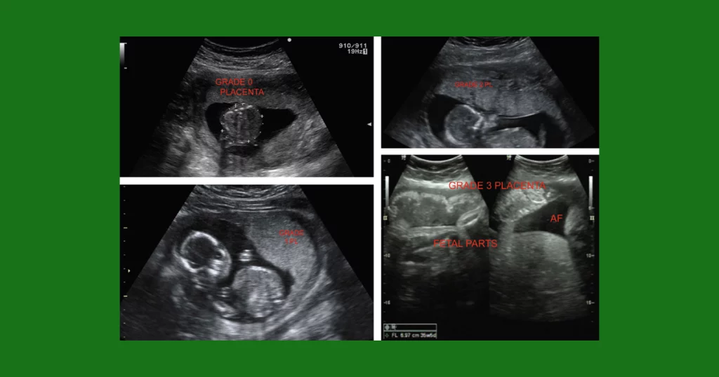 Entendendo o Grau da Placenta na Gravidez
