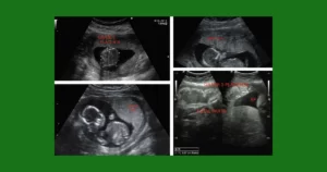 Entendendo o Grau da Placenta na Gravidez