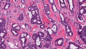 Carcinoma: Sintomas, Causas e Tratamentos Disponíveis