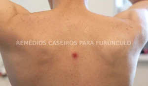 Remédios Caseiros para Furúnculo: Dicas Naturais para Alívio Rápido e Eficiente