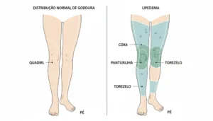 Lipedema: Como Identificar e Tratar a Gordura que Não Sai com Dieta e Exercícios